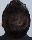 After Hair Transplant&nbsp;Front